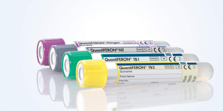 Necesario, fortalecer la detección oportuna de la tuberculosis latente